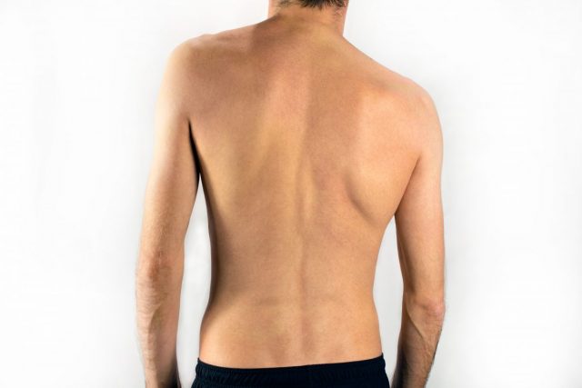 Identifying scoliosis conditions among teenagers